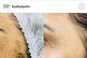 Bye Bye Pello oferece depila��o indolor est� e conquistando clientes no Shopping Popular